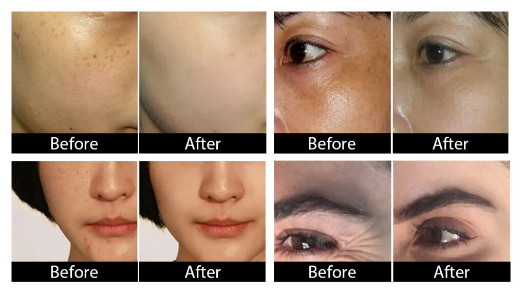 laser skin treatment