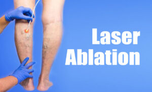 What Is Laser Ablation