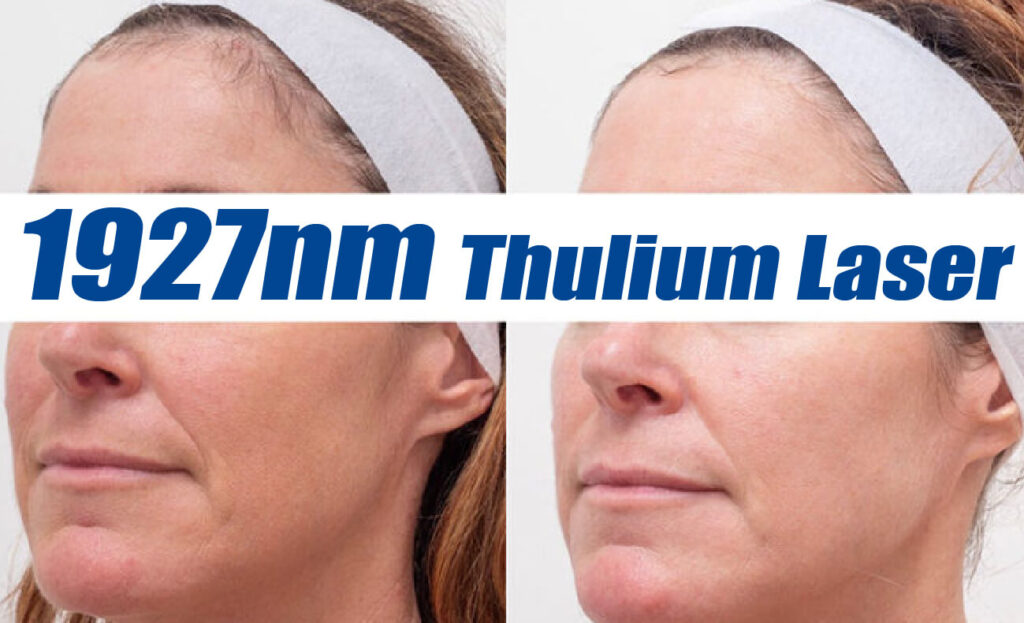 1927nm Thulium Laser